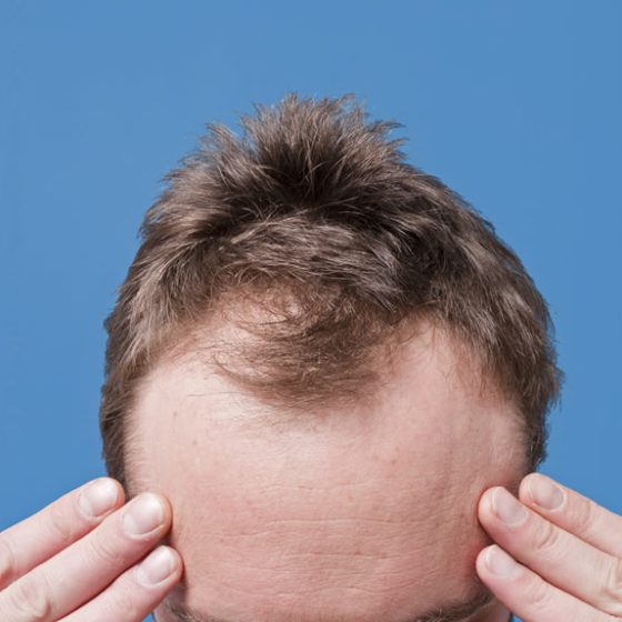 How to Stop Hair Loss in Teenage Guys