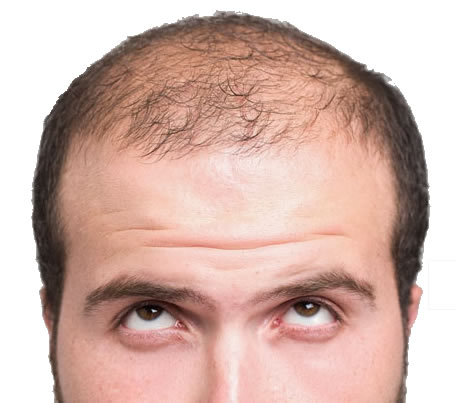 receding hairline stages